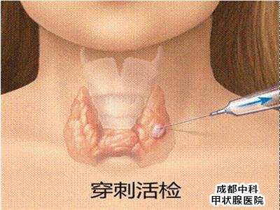重庆医治甲状腺结节医院哪个正规呢?